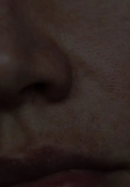 Open/Enlarged Pores