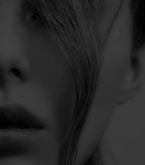 CARBON PEEL (Q-SWITCH LASER) London