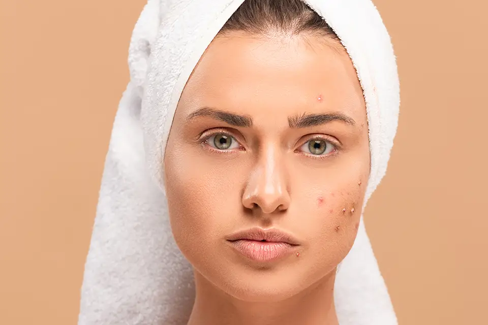 Best Home Treatment for Age Spots on Face
