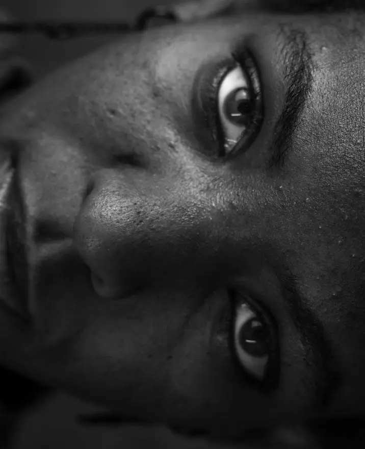 Acne (Skin Breakouts) & Acne Scarring