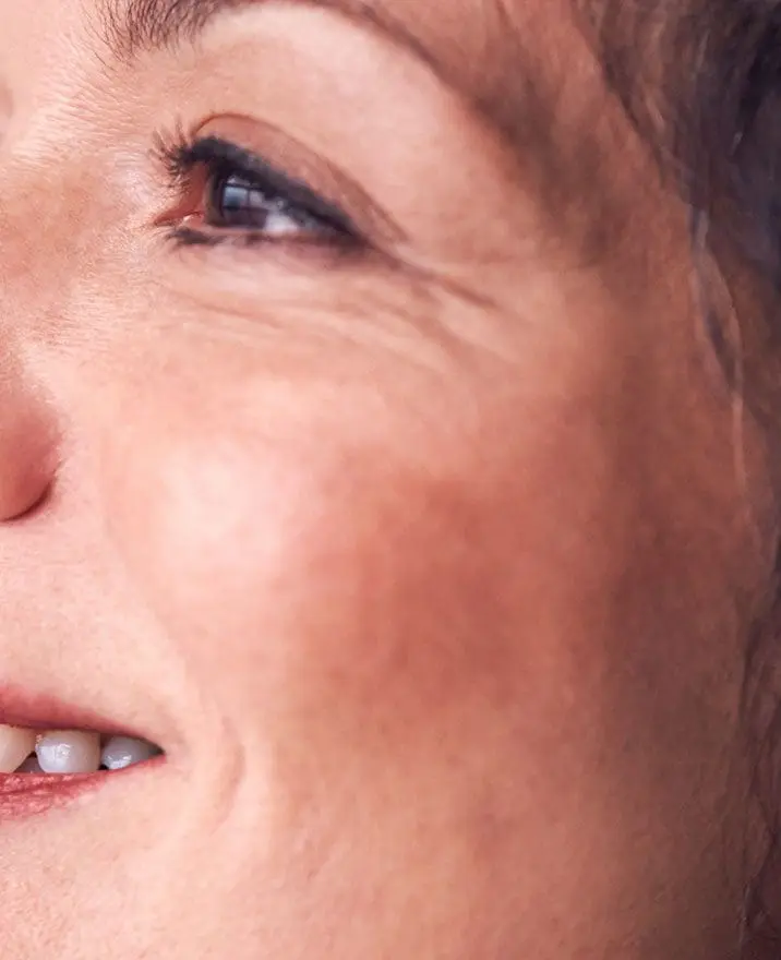 Frown, Forehead and Crow’s Feet Lines