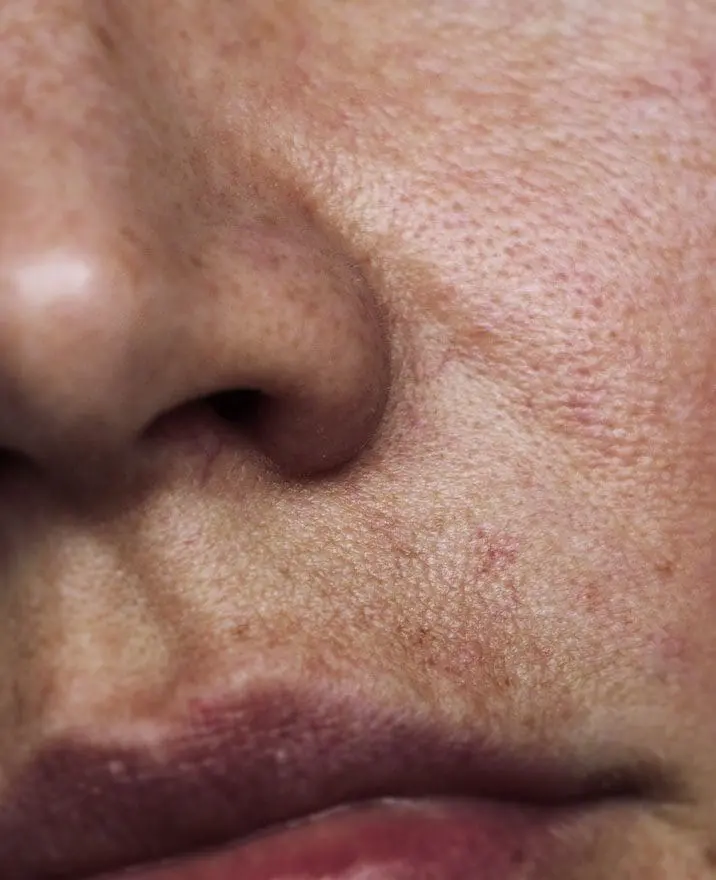 Open/Enlarged Pores