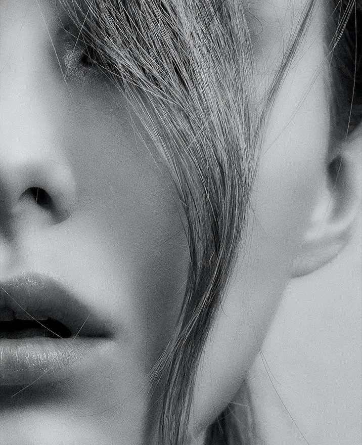 Carbon Peel (Q-Switch Laser)