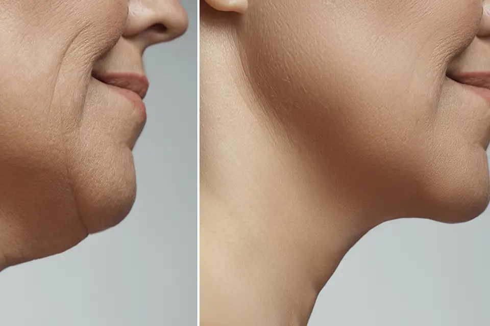 Morpheus8 For Under-Chin (Double Chin): Tightening Vs Fat Reduction—What's Realistic?